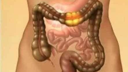 4 علامات تحذيرية مبكرة لسرطان القولون.. فما هي؟