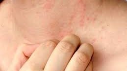 طرق علاج والوقاية من حمو النيل والدمامل للكبار والأطفال