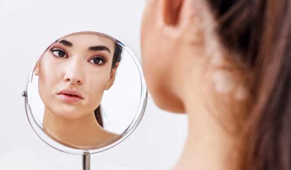 الفرق بين البقع البيضاء والبهاق