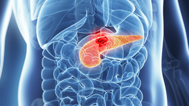 إكتشاف جديد يمنح الأمل لمرضى سرطان البنكرياس