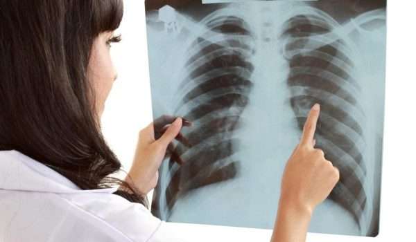 أعراضه بتحصل لكتير مننا.. ما هو سرطان الرئة وما أسبابه وطرق الوقاية منه؟