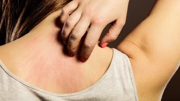 كل ما تود معرفته عن الحكة الجلدية