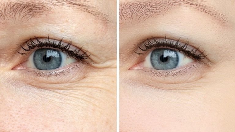 علاج التجاعيد تحت العين 