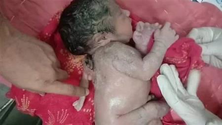 طفل ب 3 ايادي