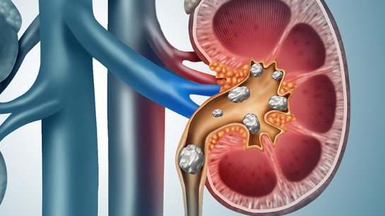 حصوات الكلى