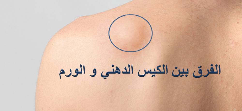 الكيس الدهني