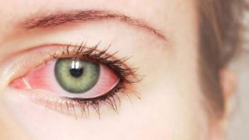 علامات  في العين تشير الي فرط الغدة الدرقية