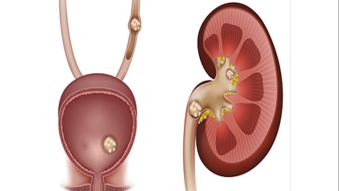 حصوات الكلى 