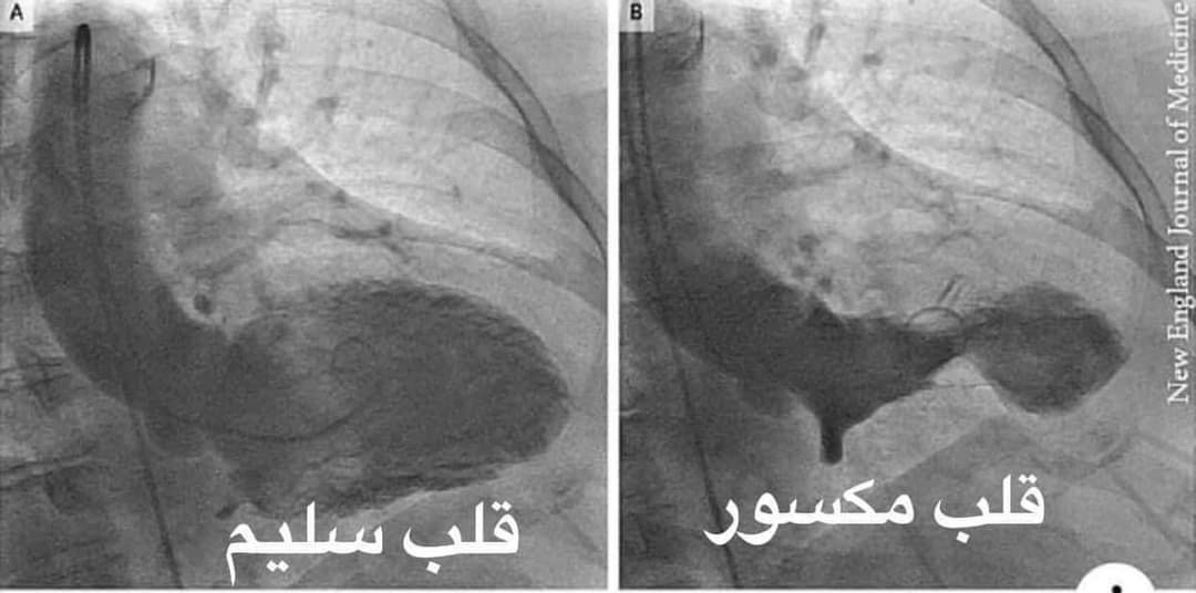 لقطة من أشعة تعبر عن القلب المكسور