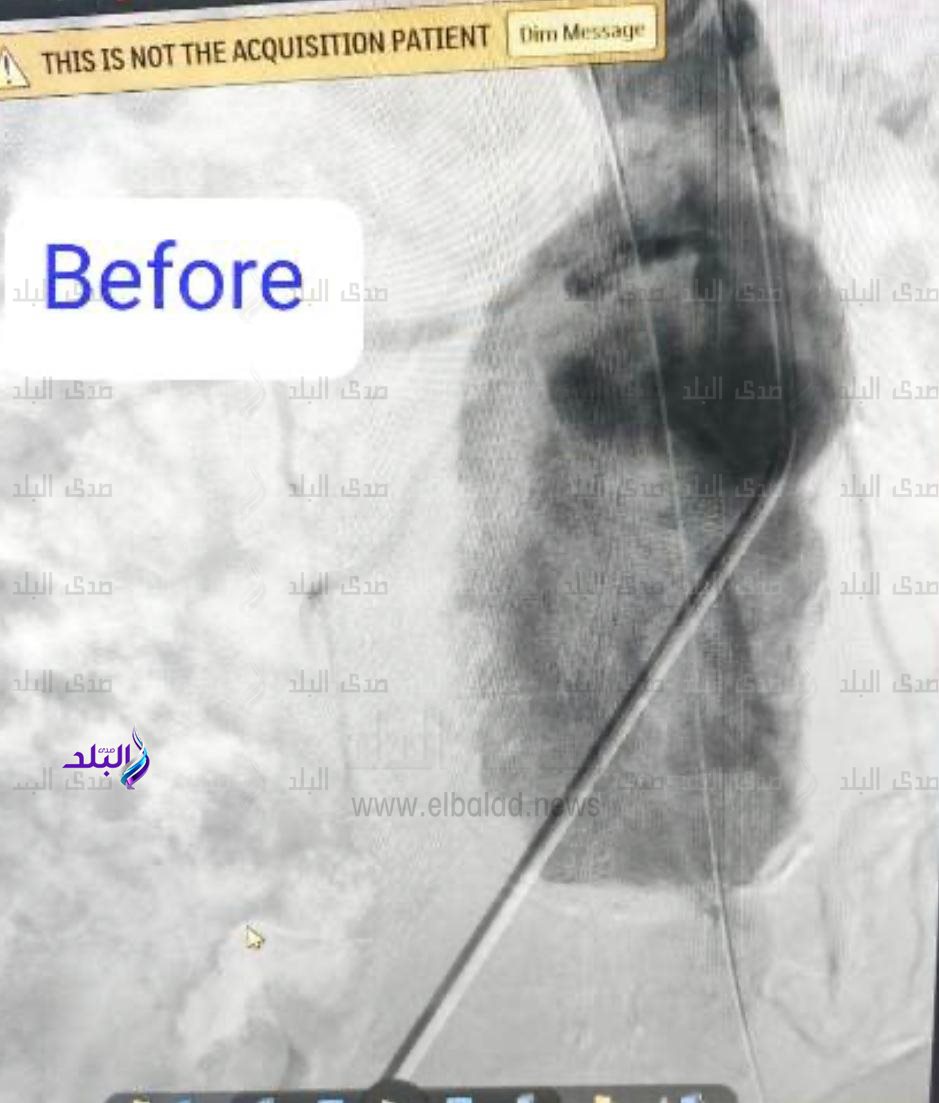 تركيب قسطرة دقيقة جداً لمريض يعاني من تمدد كبير في الشريان الأورطي والشريان الحرقفي الايمن