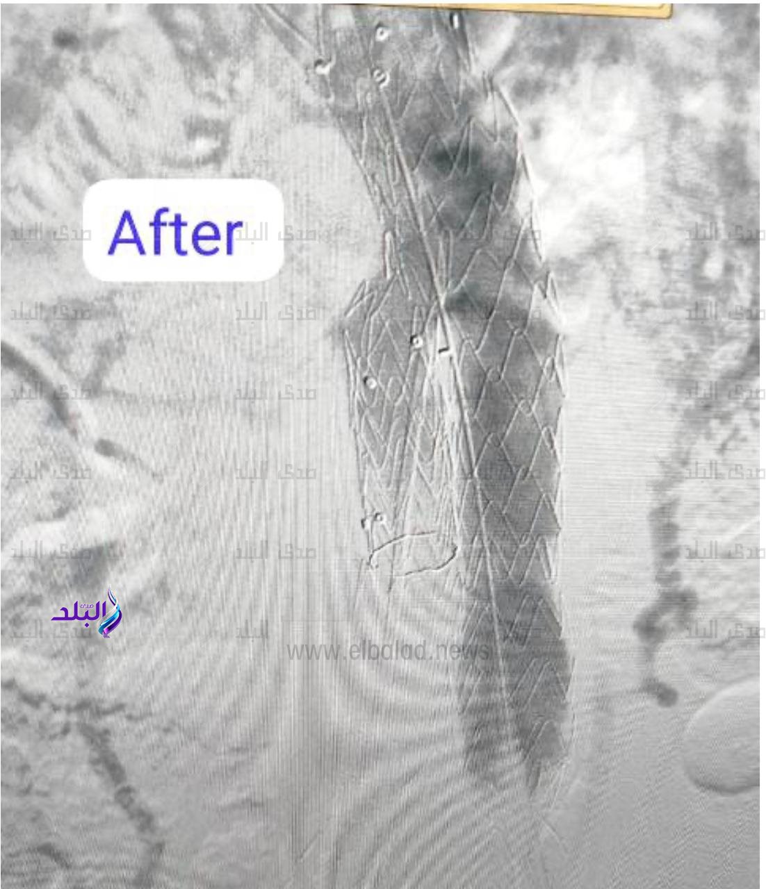 تركيب قسطرة دقيقة جداً لمريض يعاني من تمدد كبير في الشريان الأورطي والشريان الحرقفي الايمن