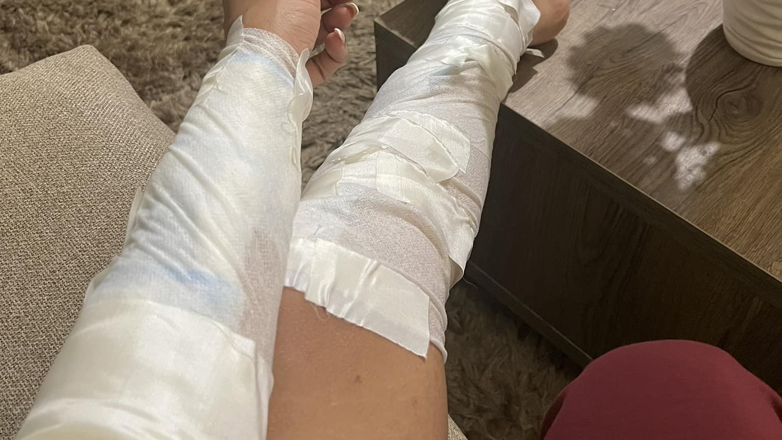 حرق راندا عبد السلام من الدرجة الأولى 