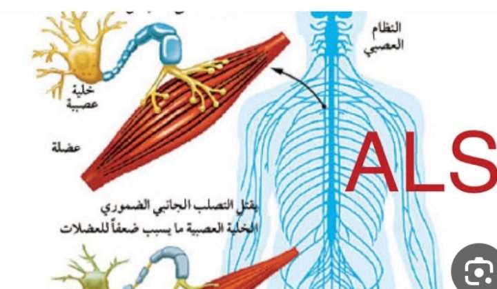 التصلب الجانبي الضموري