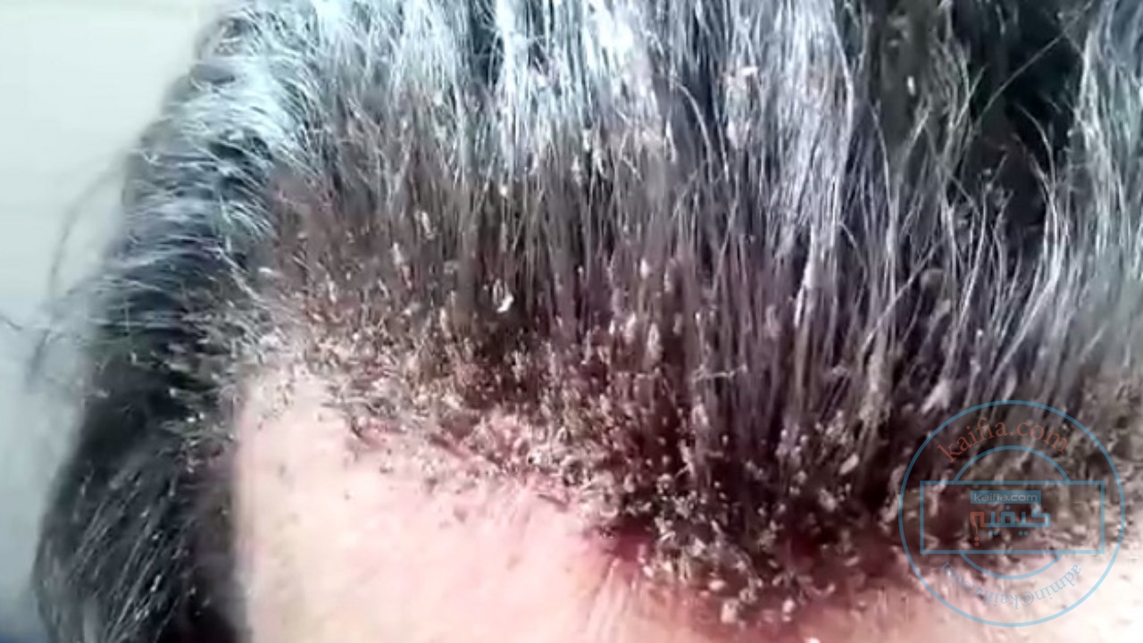 القمل القمل