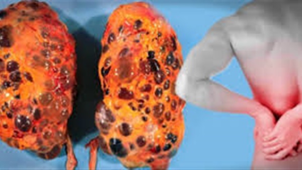 تناول كوب من هذا المشروب السحري يغسل الكلي من السموم 