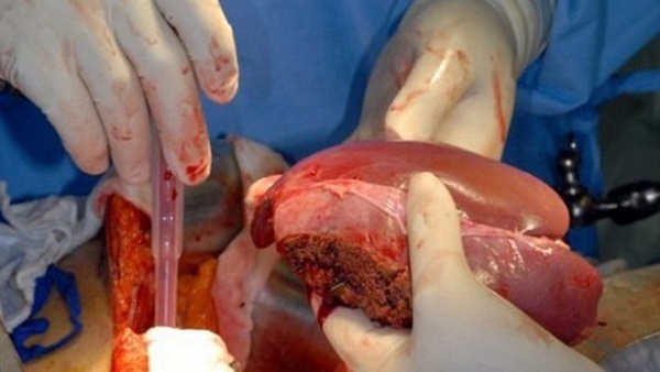 تجارة الأعضاء - صورة أرشيفية