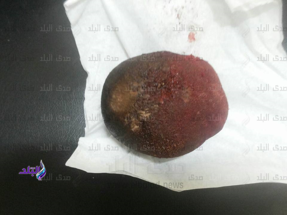 استئصال حصوة مثانة زنة 600 جرام لمريض الفيوم