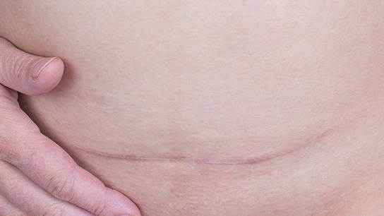 تقنية جديدة لإخفاء الأثاء الناتجة عن جروح العمليات تماما