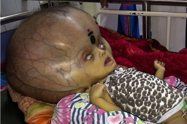 نجاح عملية تصغير أكبر رأس طفل بالعالم