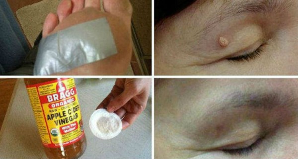 طرق طبيعية تخلصك من الزوائد الجلدية بأمان فى 10 أيام فقط