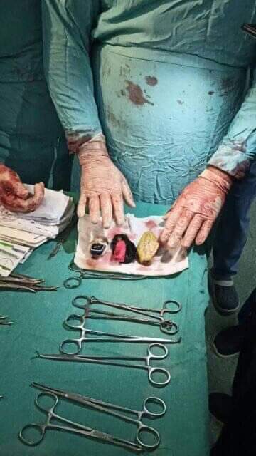 استخراج موبايل وولاعة من بطن مريض بالمنصورة 