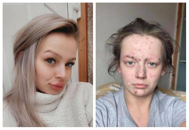 مدمنة مخدرات سابقة تشارك صورًا لها قبل وبعد التعافي 