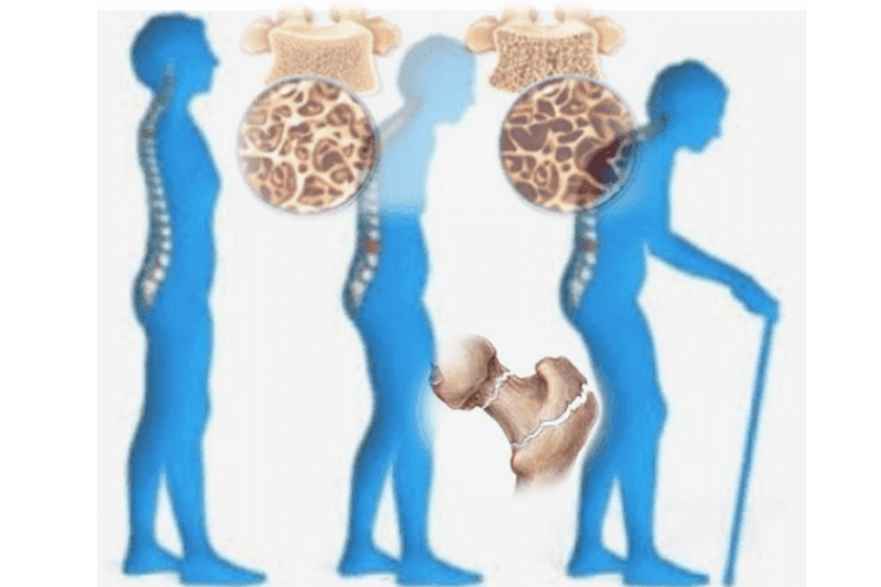 ماعلاقة هشاشة العظام بالم العمود الفقري