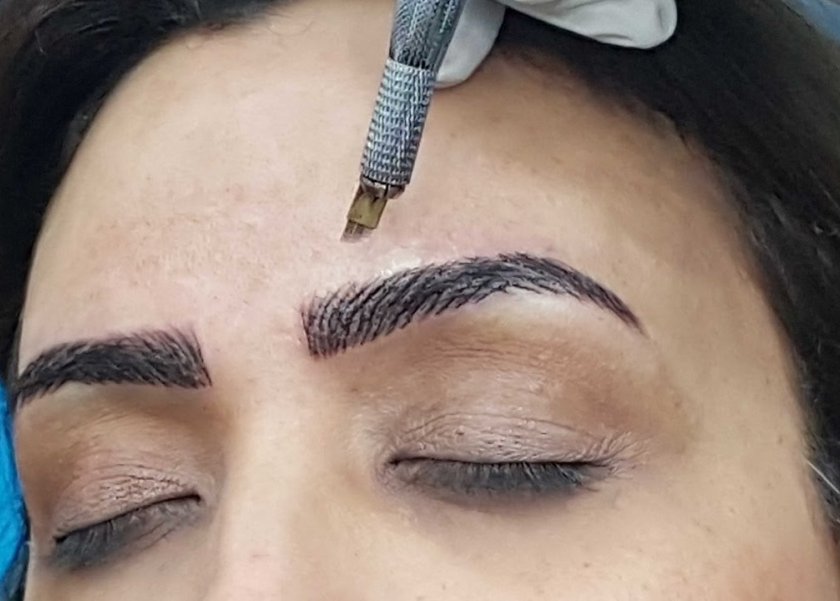 حكم المايكروبليدنج