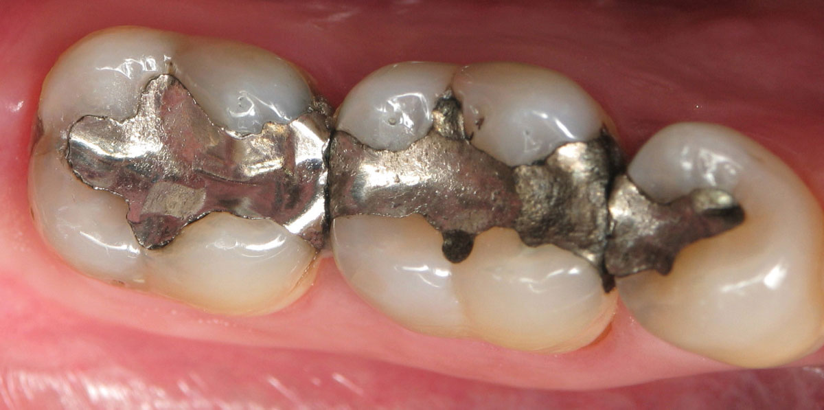 حكم الصيام بعد حشو الضرس ووجود طعم في الفم؟ الإفتاء ترد