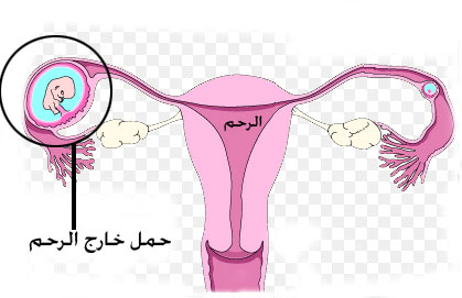 اعراض وعلاج الحمل خارج الرحم