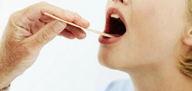 طرق علاج التهاب اللوزتين