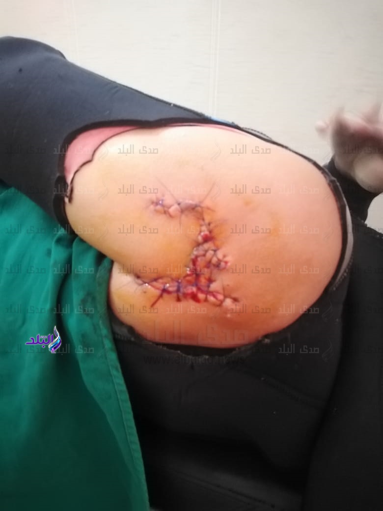 سمكة قرش تهاجم سائحة ألمانية 