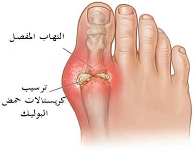 علاج النقرس بالادوية والطرق المنزلية