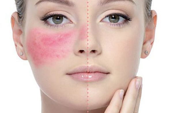 علاج حساسية الكمامة 