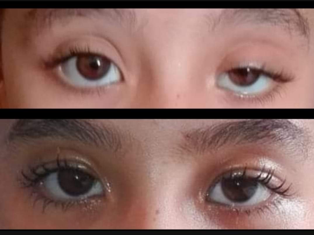 مرضى العيون