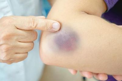 علاج الكدمات