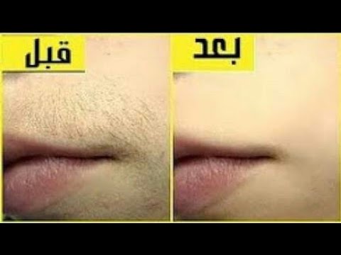 إزالة شعر الوجة