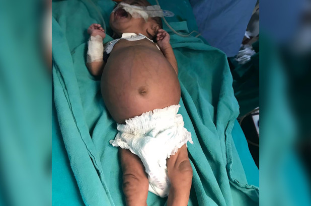 استخراج جنين من بطن رضيعة