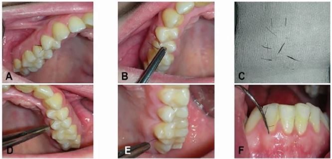 نمو شعر بين أسنان امراة 