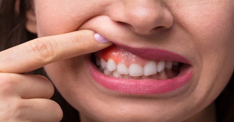 علاج ورم اللثة