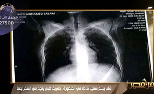 شاب يبتلع سكينة 