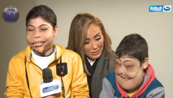 شقيقان مصابان بمرض نادر في الوجه