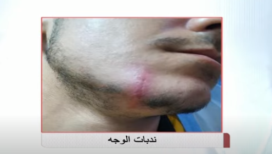 ندبات الوجه