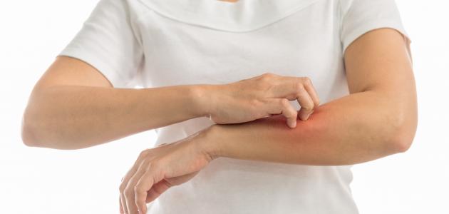 . دراسة توضح تأثير كورونا على الجلد بـ 3 علامات