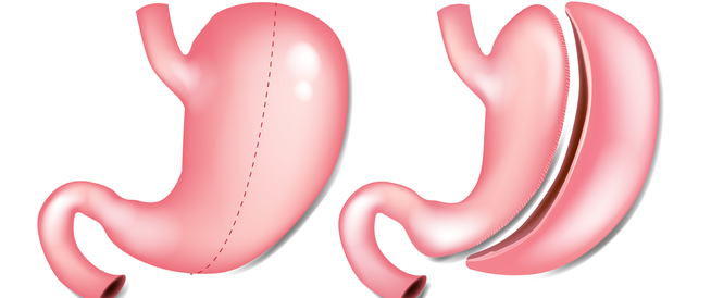  عملية تكميم المعدة 