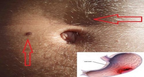 10 علامات تظهر على جسمك عند إصابتك بسرطان المعدة