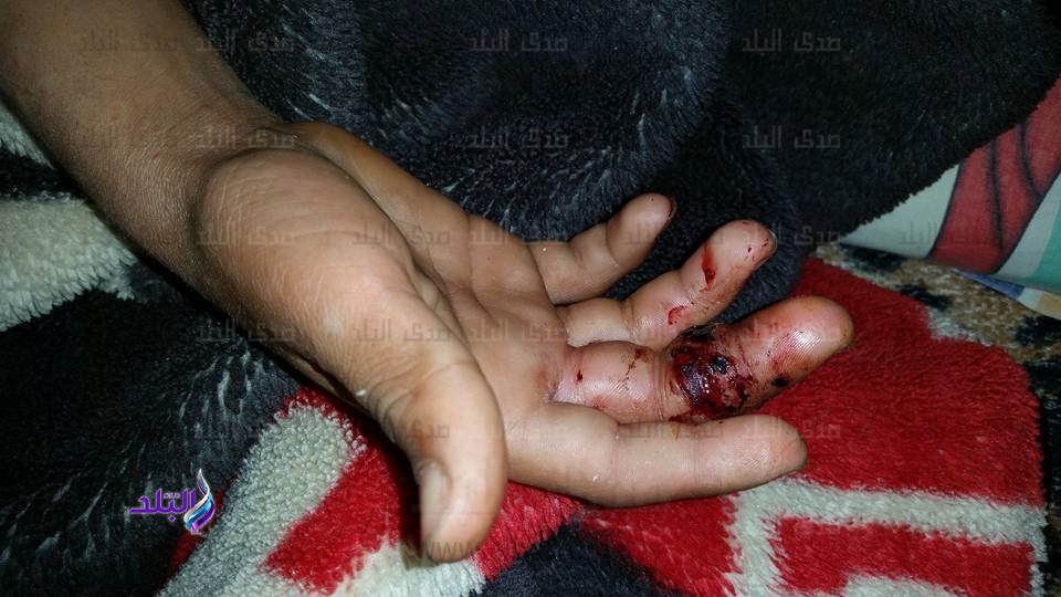 أحد الأطفال المصابين أحد الأطفال المصابين