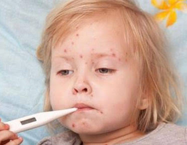 الجدري المائي