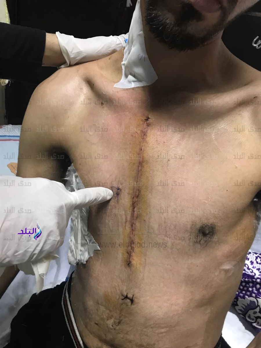 فريق جراحى بطوارئ المنصورة يجرى جراحة نادرة بالقلب لاحد الشب