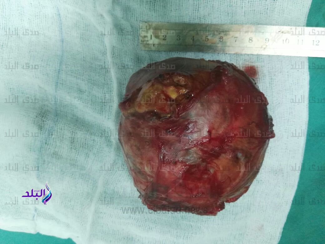 استئصال "ورم كبير" لسيدة في مستشفى قنا الجامعي